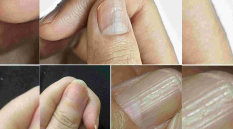 Understanding the Real Causes of Vertical Ridges on Your Nails