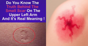 The Smallpox Vaccine Scar What It Means and Why It Still Matters