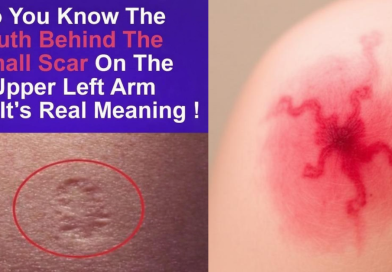 The Smallpox Vaccine Scar What It Means and Why It Still Matters